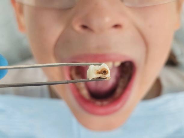 Best Emergency Tooth Extraction in Nneconne, WI